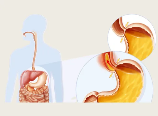 Stomach & Esophageal Disorders